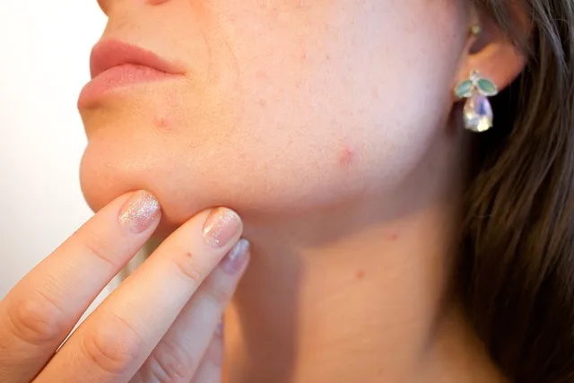 Skincare products arranged to treat acne and breakouts